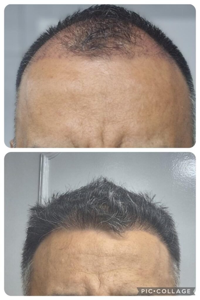 Antes y despues trasplante capilar Sr Garzon