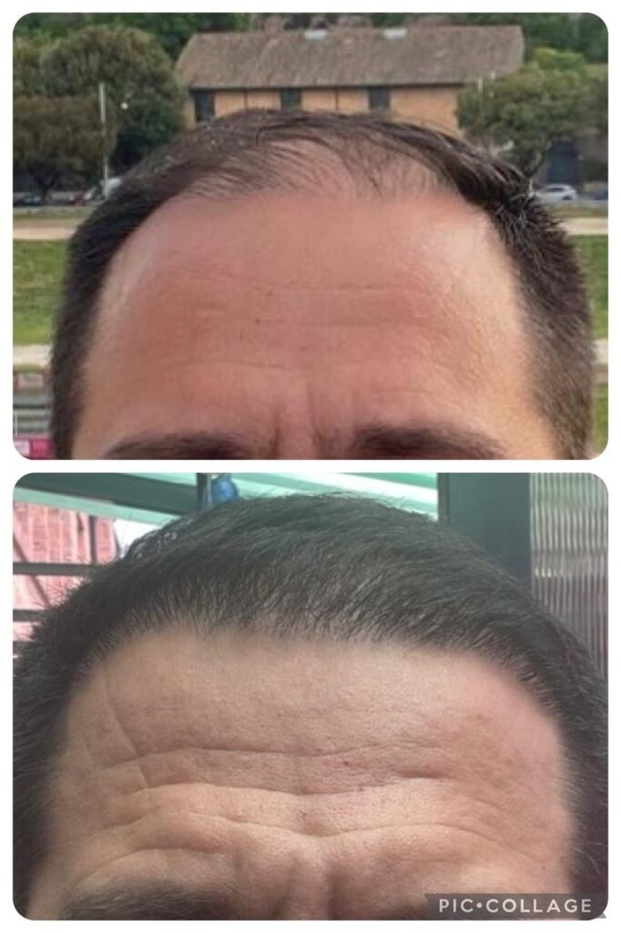 Antes y despues trasplante capilar Sr Hincapie