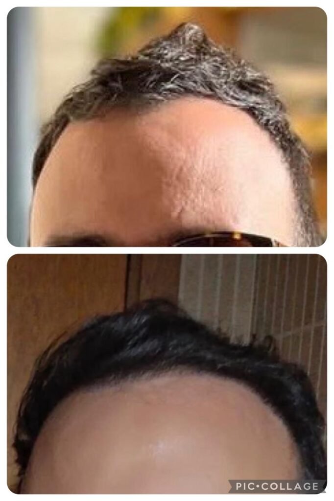 Antes y despues trasplante capilar Sr Quintero
