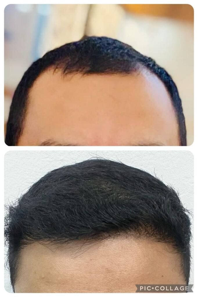 Antes y despues trasplante capilar Sr Sossa