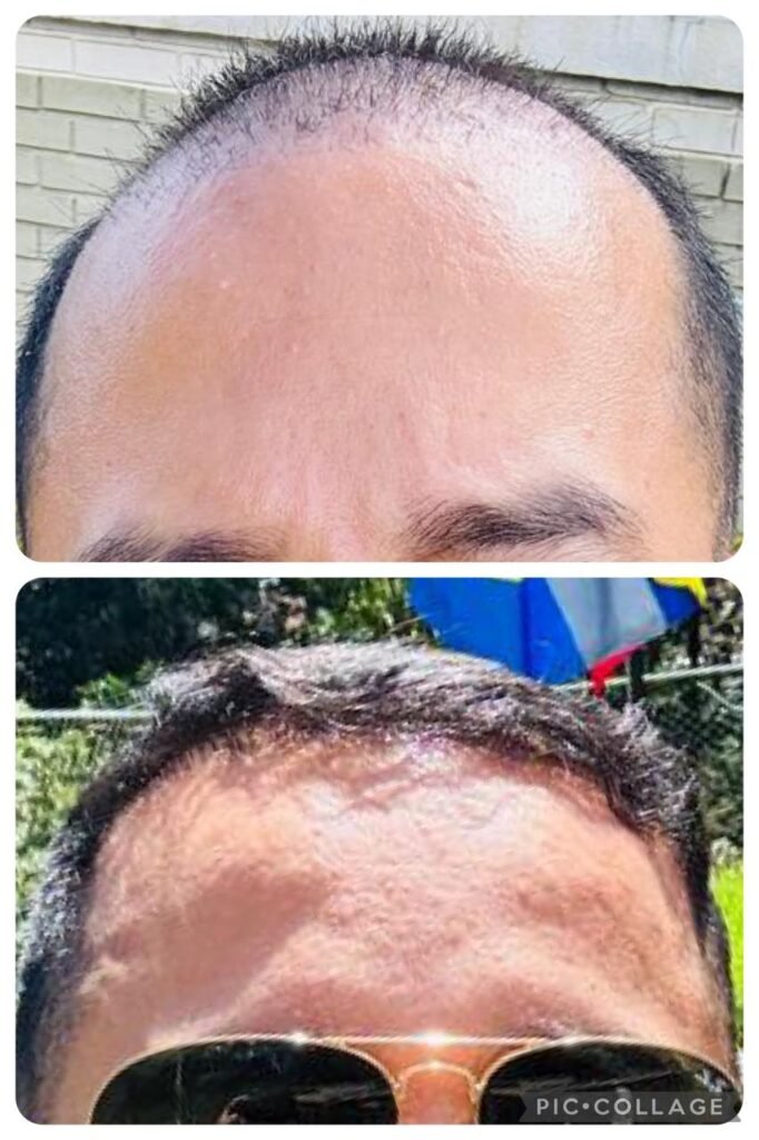 Antes y despues trasplante capilar Sr Tierradentro